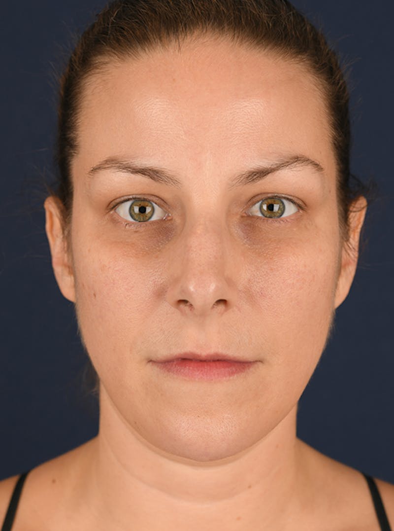 Rhinoplasty Before & After Gallery - Patient 9708954 - Image 1