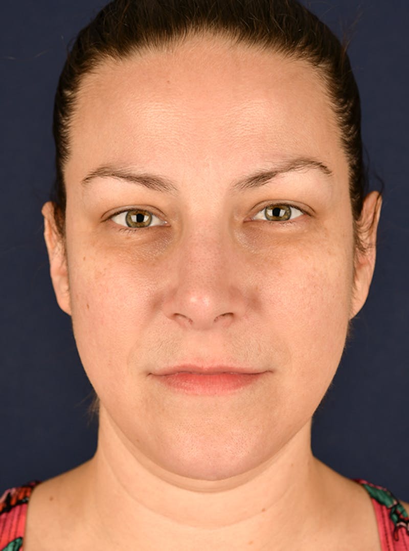 Rhinoplasty Before & After Gallery - Patient 9708954 - Image 2