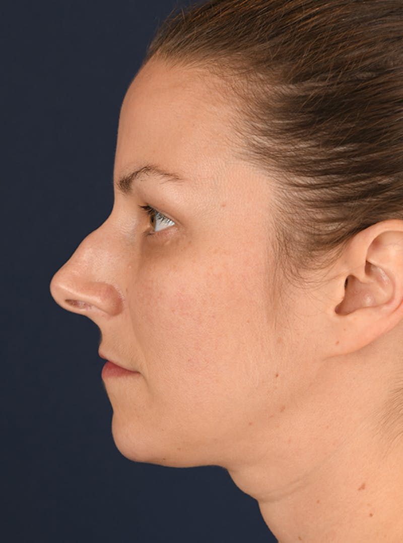 Rhinoplasty Before & After Gallery - Patient 9708954 - Image 5