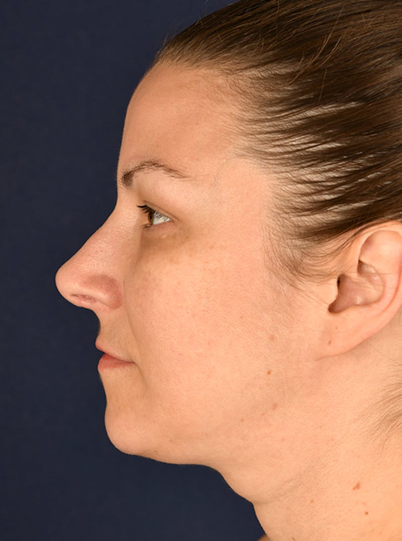 Rhinoplasty Before & After Gallery - Patient 9708954 - Image 6