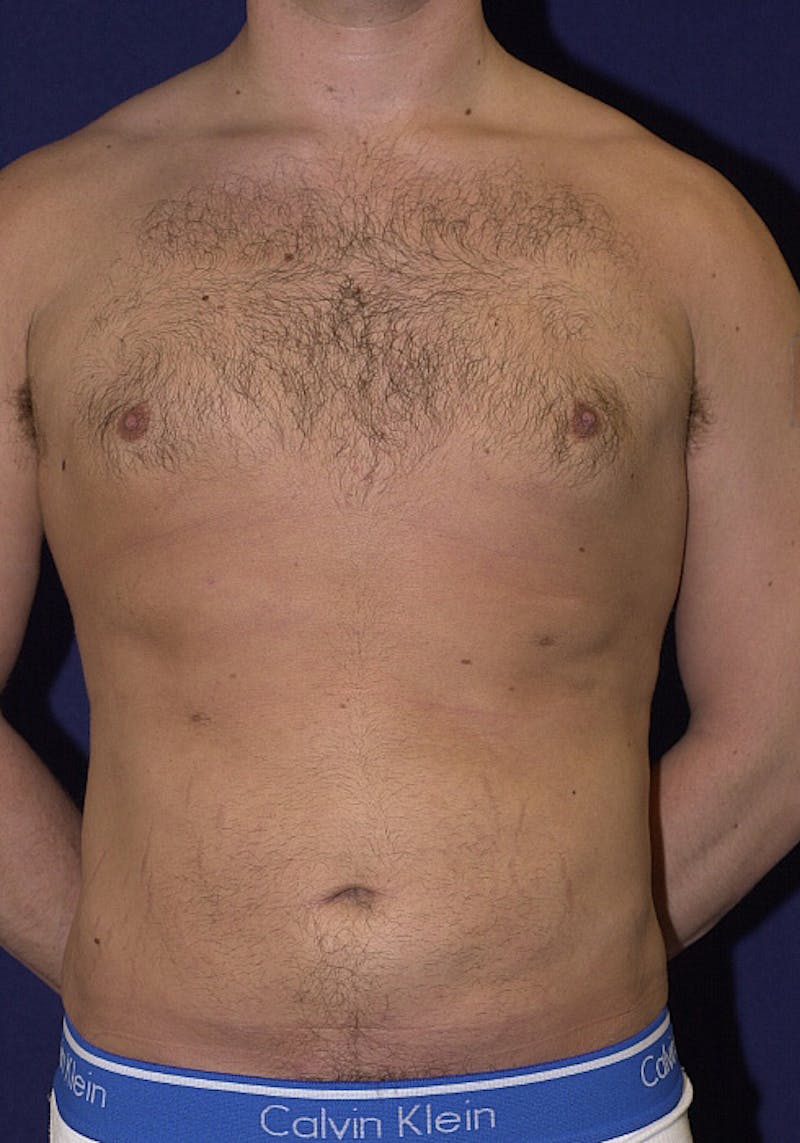 Gynecomastia Before & After Gallery - Patient 9710082 - Image 1