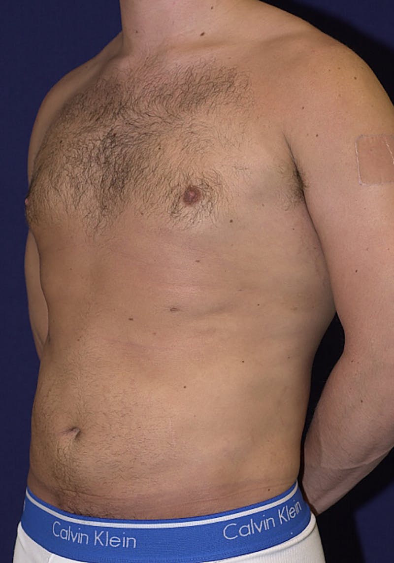Gynecomastia Before & After Gallery - Patient 9710082 - Image 3
