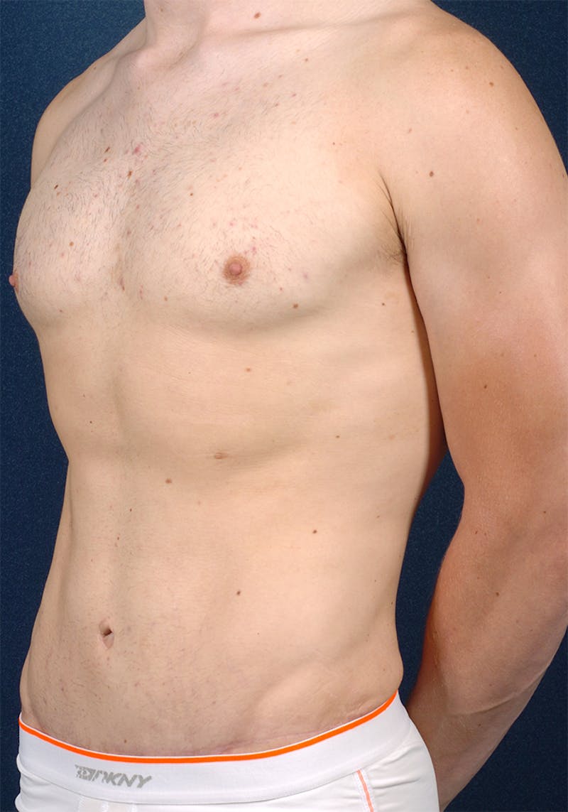 Gynecomastia Before & After Gallery - Patient 9710082 - Image 4