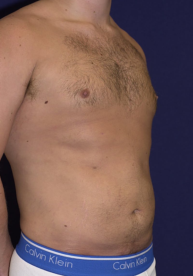 Gynecomastia Before & After Gallery - Patient 9710082 - Image 5