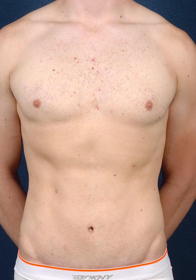 Male Liposuction Before & After Gallery - Patient 9710085 - Image 2