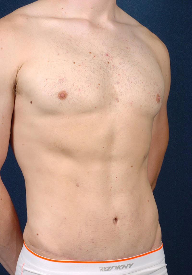 Gynecomastia Before & After Gallery - Patient 9710082 - Image 6