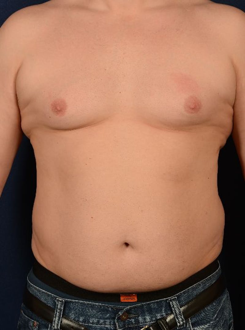 Gynecomastia Before & After Gallery - Patient 9710086 - Image 1