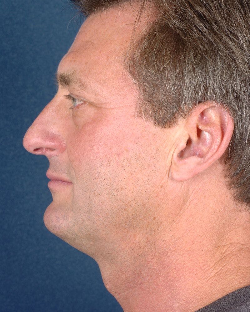Facial Rejuvenation Before & After Gallery - Patient 9710084 - Image 5
