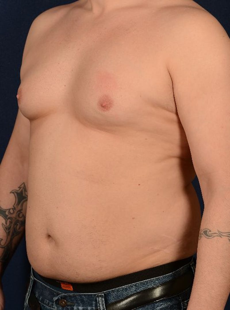 Gynecomastia Before & After Gallery - Patient 9710086 - Image 3