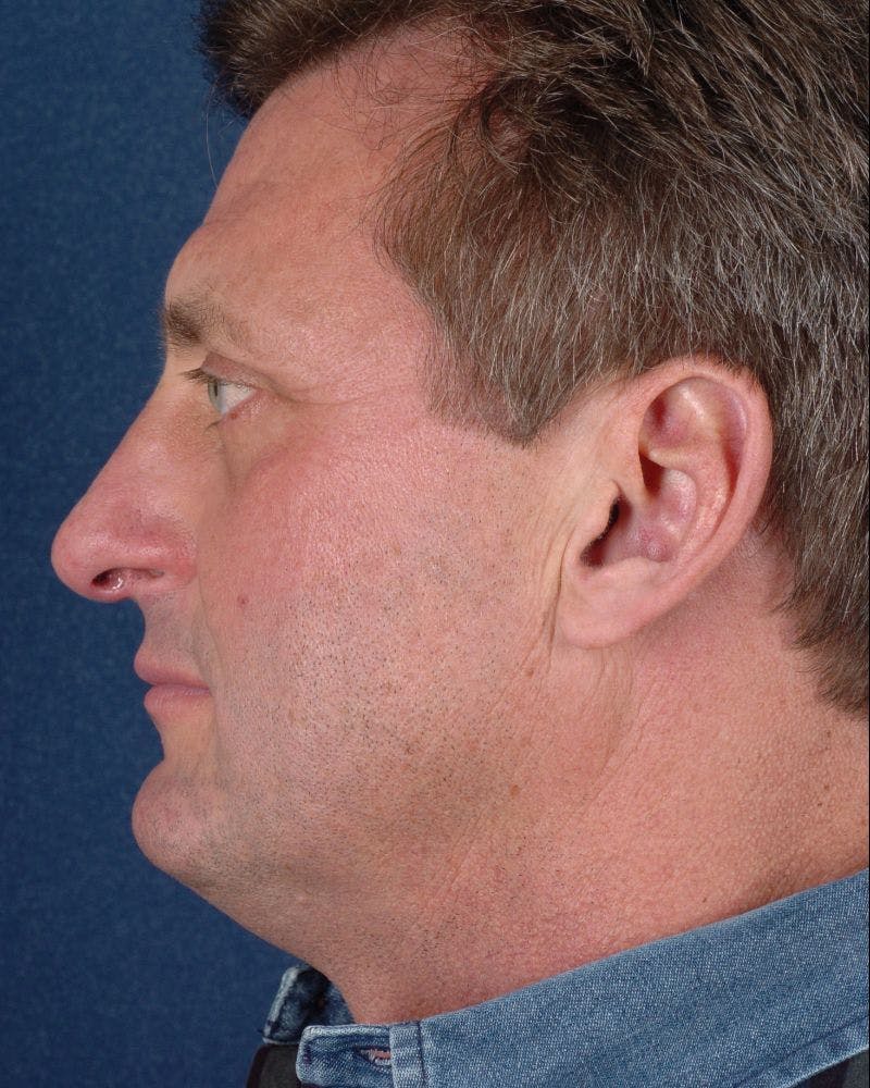Facial Rejuvenation Before & After Gallery - Patient 9710084 - Image 6