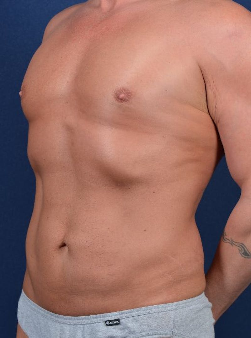Gynecomastia Before & After Gallery - Patient 9710086 - Image 4