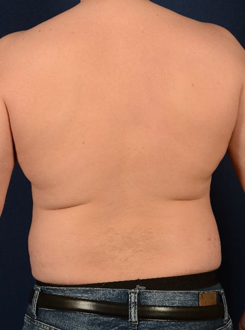 Gynecomastia Before & After Gallery - Patient 9710086 - Image 5