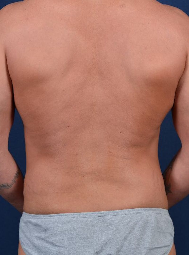 Gynecomastia Before & After Gallery - Patient 9710086 - Image 6