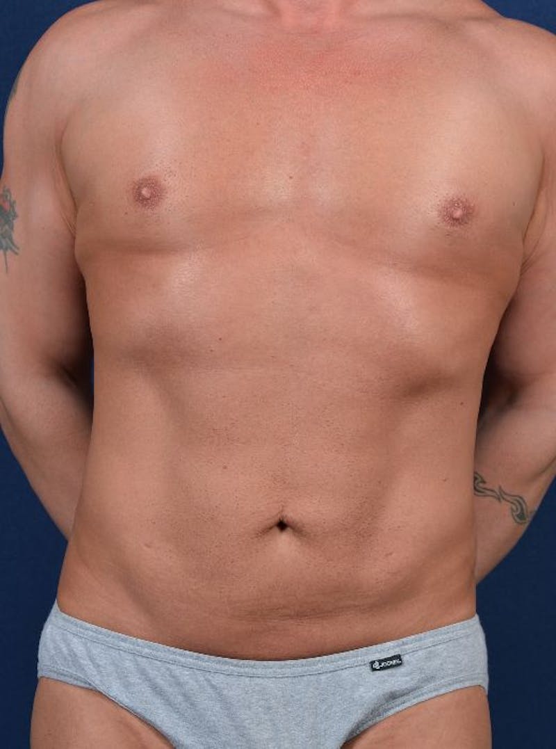 Male Liposuction Before & After Gallery - Patient 9710089 - Image 2