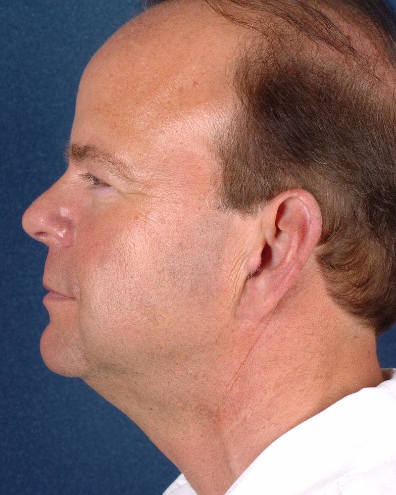 Facial Rejuvenation Before & After Gallery - Patient 9710090 - Image 3