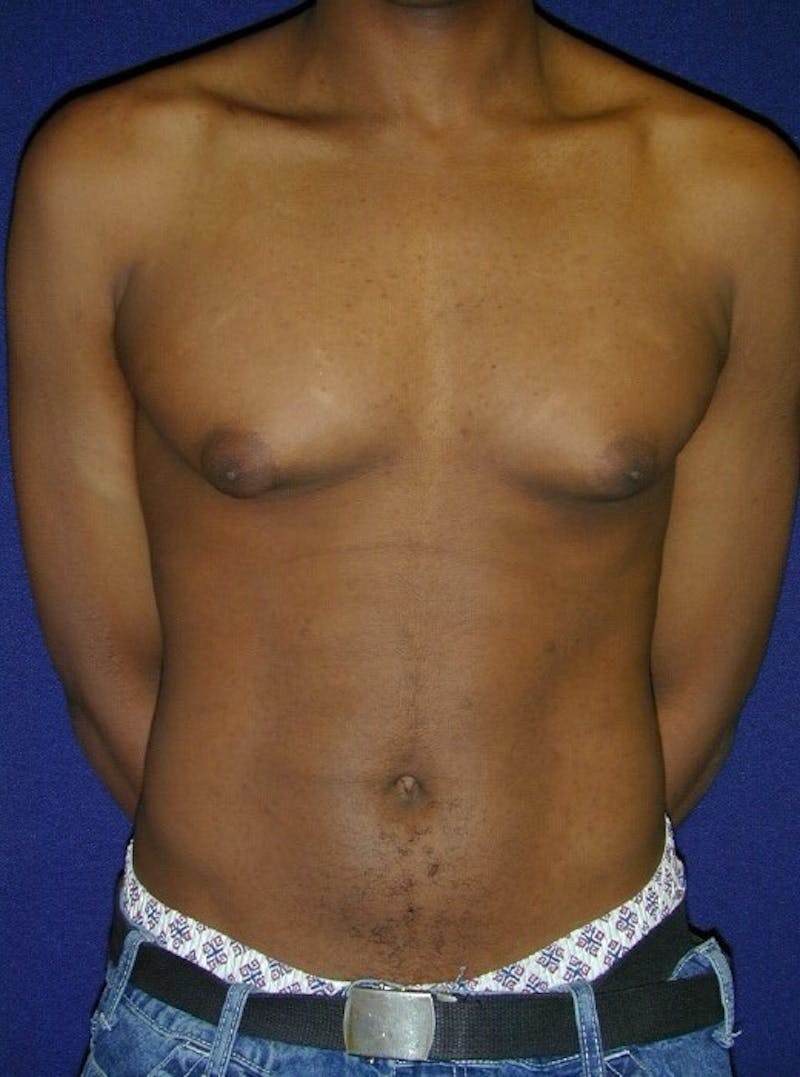 Gynecomastia Before & After Gallery - Patient 9710092 - Image 1
