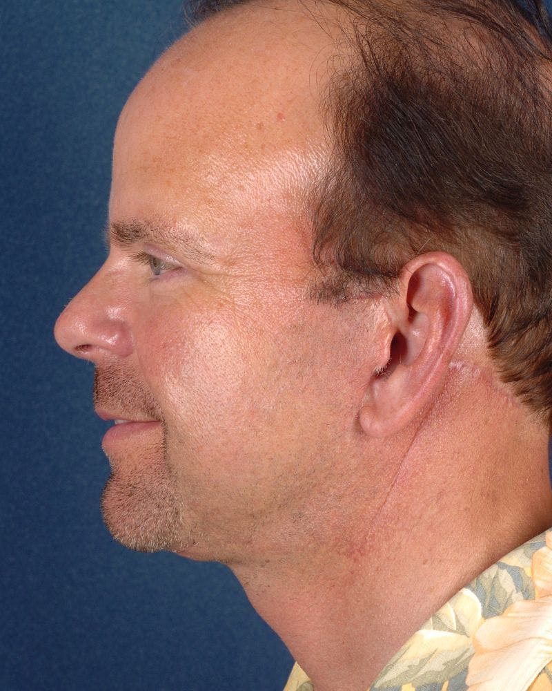 Facial Rejuvenation Before & After Gallery - Patient 9710090 - Image 4