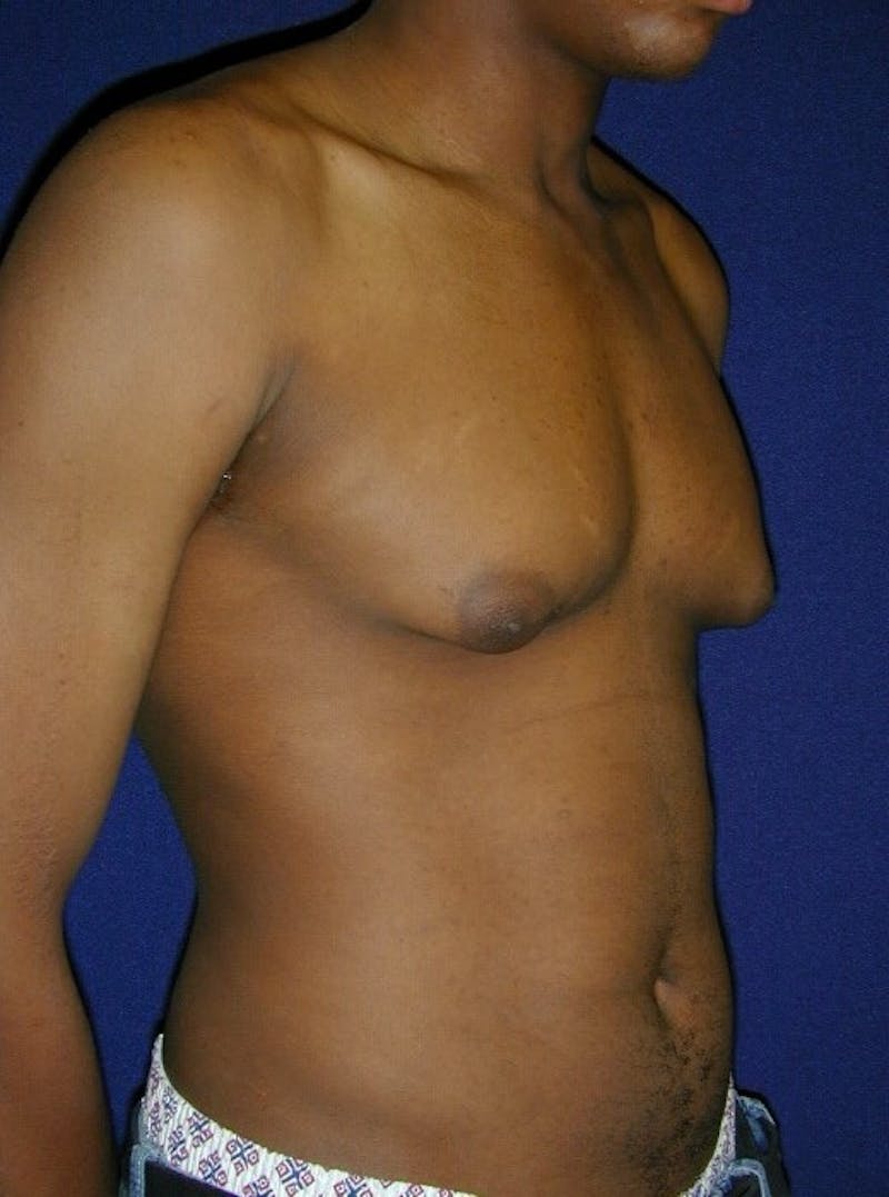 Gynecomastia Before & After Gallery - Patient 9710092 - Image 3