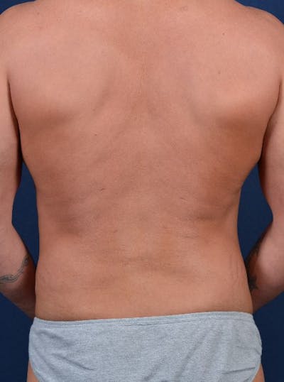 Male Liposuction Before & After Gallery - Patient 9710089 - Image 6