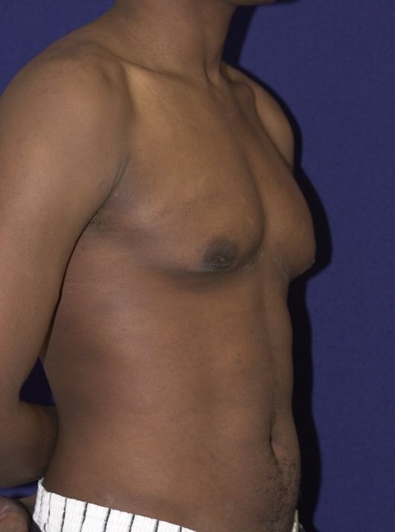 Gynecomastia Before & After Gallery - Patient 9710092 - Image 4