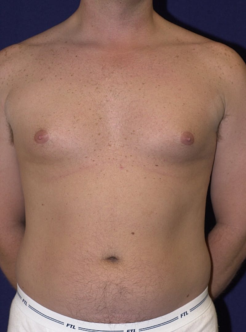 Male Liposuction Before & After Gallery - Patient 9710093 - Image 1