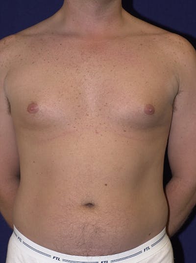 Male Liposuction Before & After Gallery - Patient 9710093 - Image 1