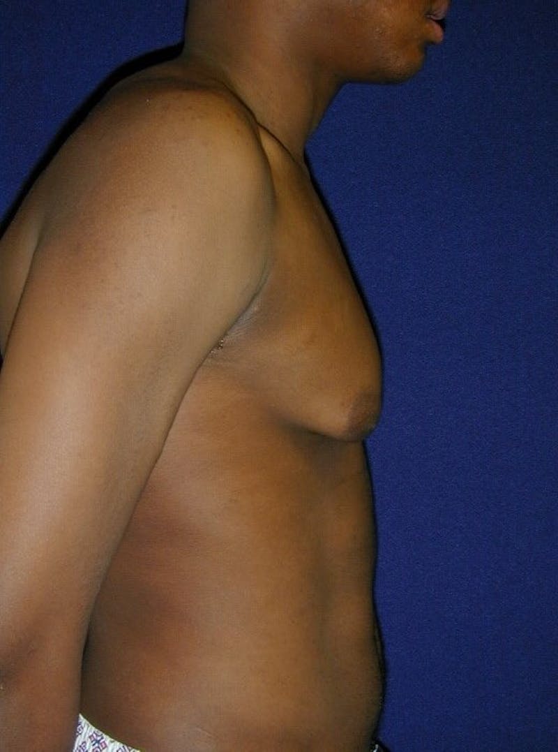 Gynecomastia Before & After Gallery - Patient 9710092 - Image 5