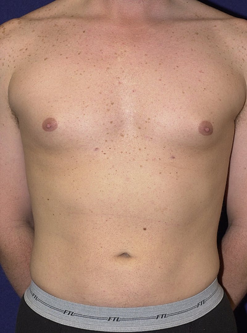 Male Liposuction Gallery - Patient 9710093 - Image 2
