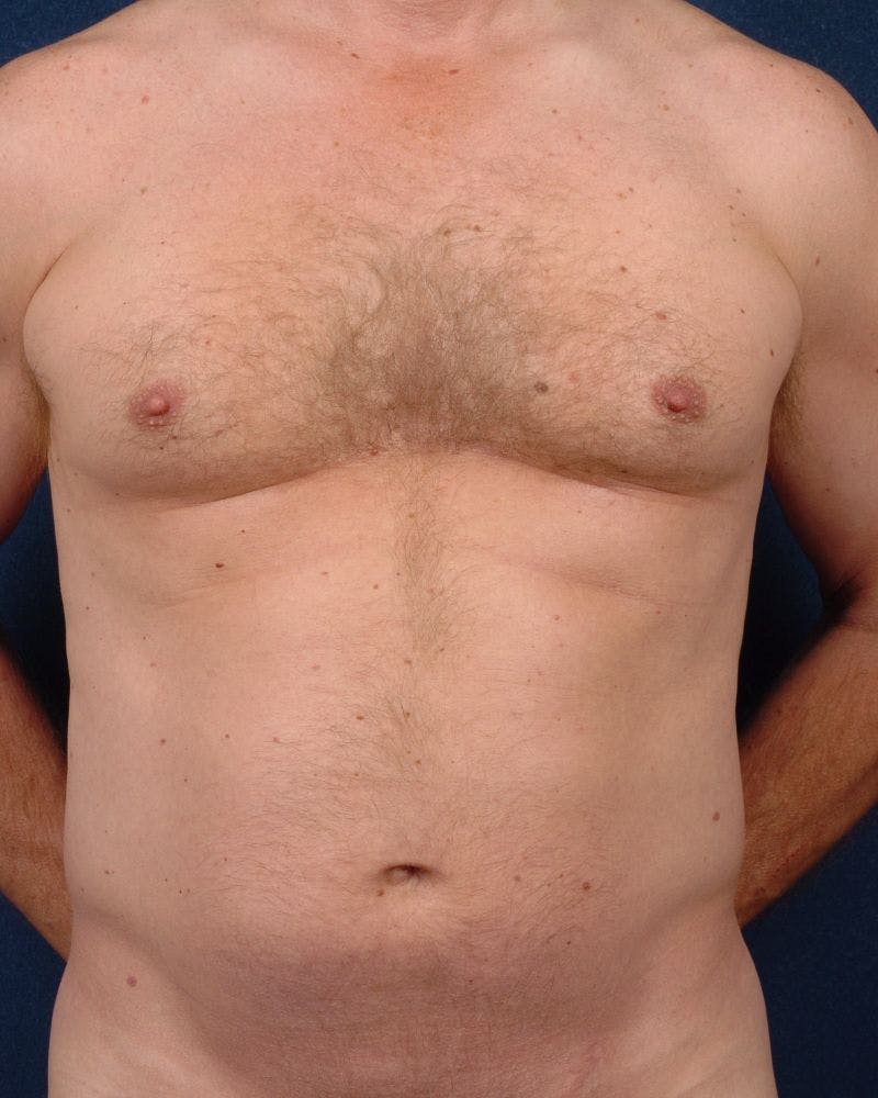 Gynecomastia Before & After Gallery - Patient 9710094 - Image 1
