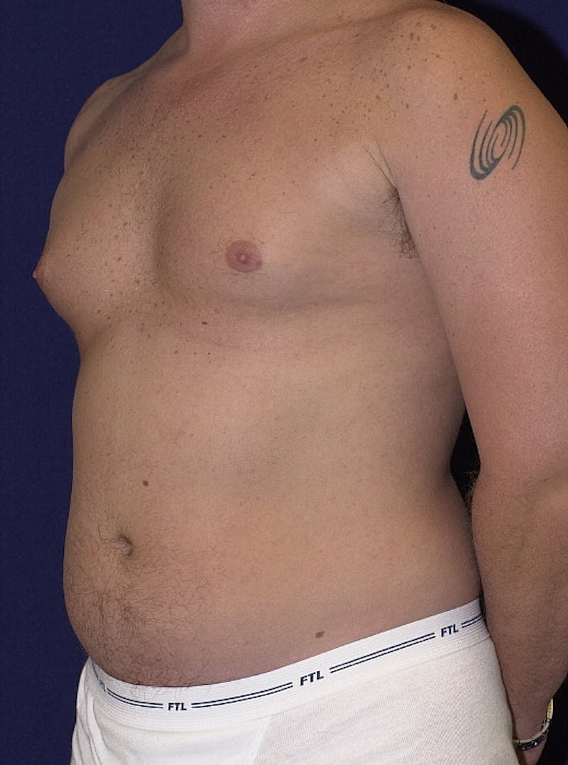 Male Liposuction Before & After Gallery - Patient 9710093 - Image 3