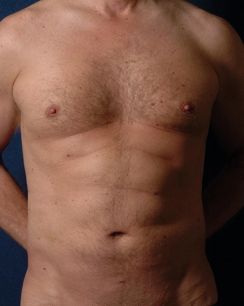 Gynecomastia Before & After Gallery - Patient 9710094 - Image 2