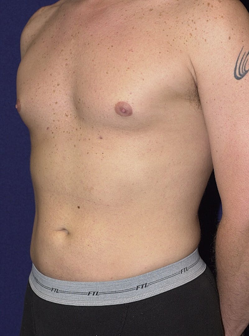 Male Liposuction Before & After Gallery - Patient 9710093 - Image 4