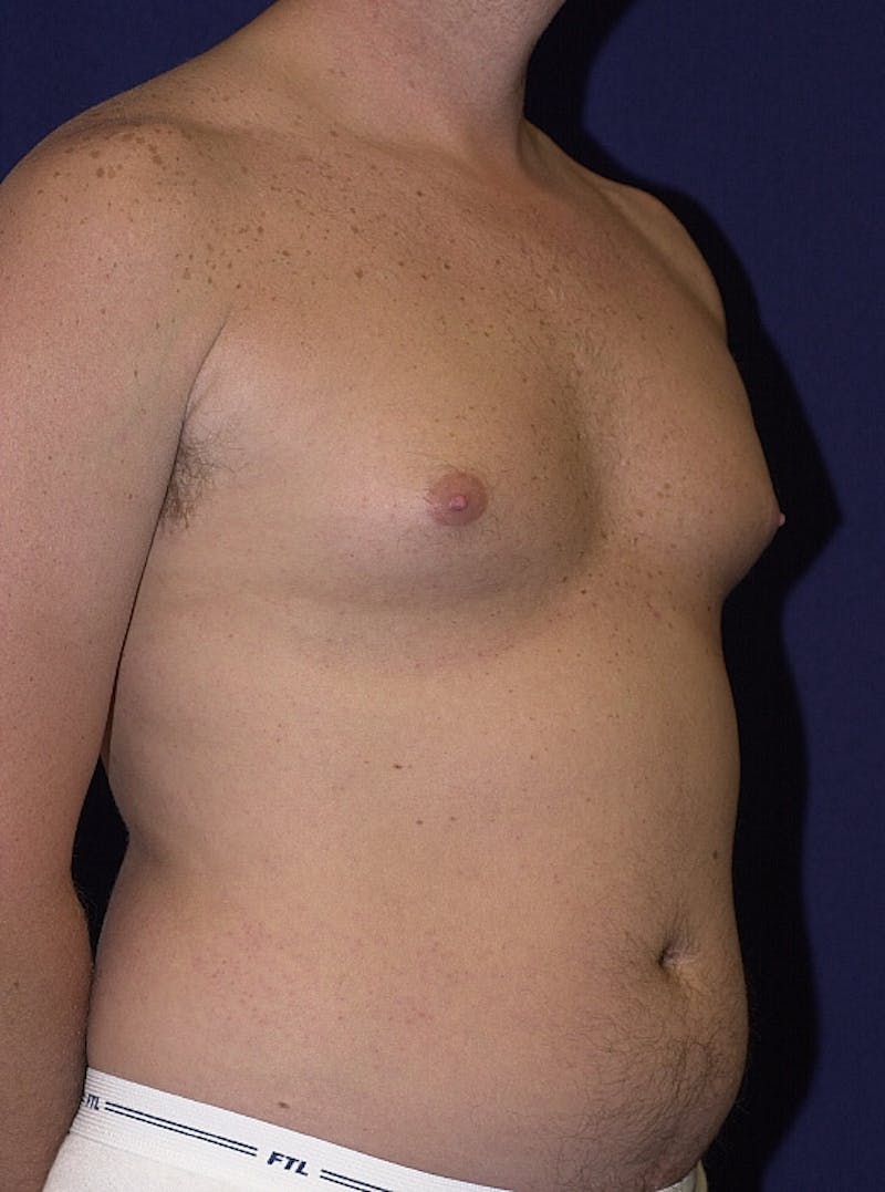 Male Liposuction Before & After Gallery - Patient 9710093 - Image 5