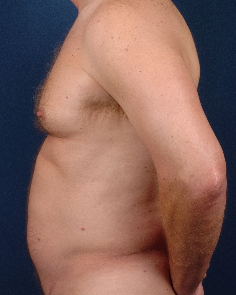 Gynecomastia Before & After Gallery - Patient 9710094 - Image 3