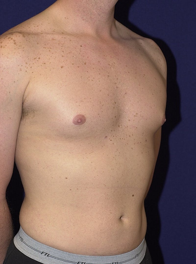 Male Liposuction Before & After Gallery - Patient 9710093 - Image 6