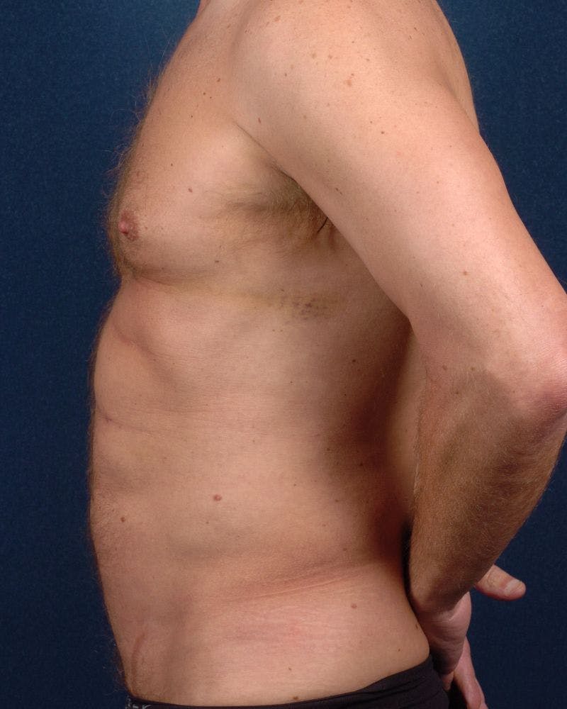 Gynecomastia Before & After Gallery - Patient 9710094 - Image 4