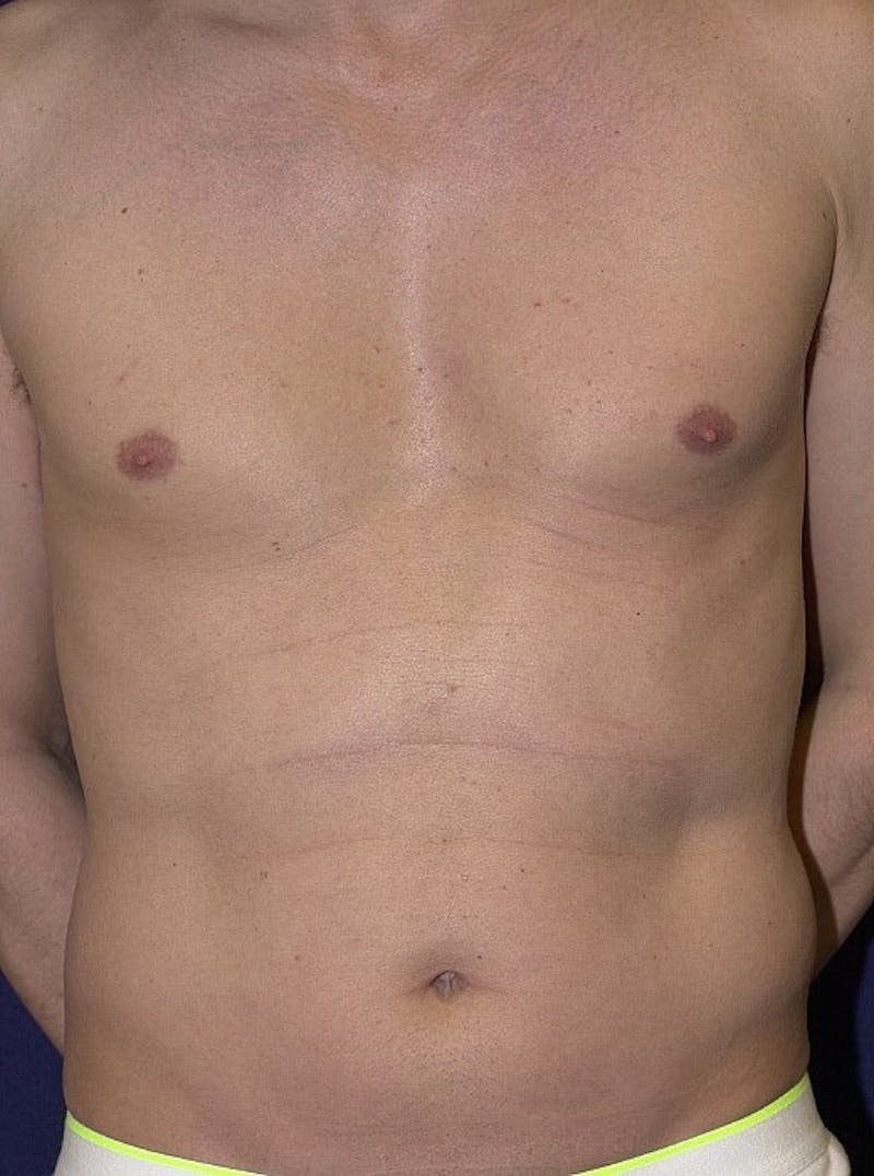 Male Liposuction Before & After Gallery - Patient 9710097 - Image 1