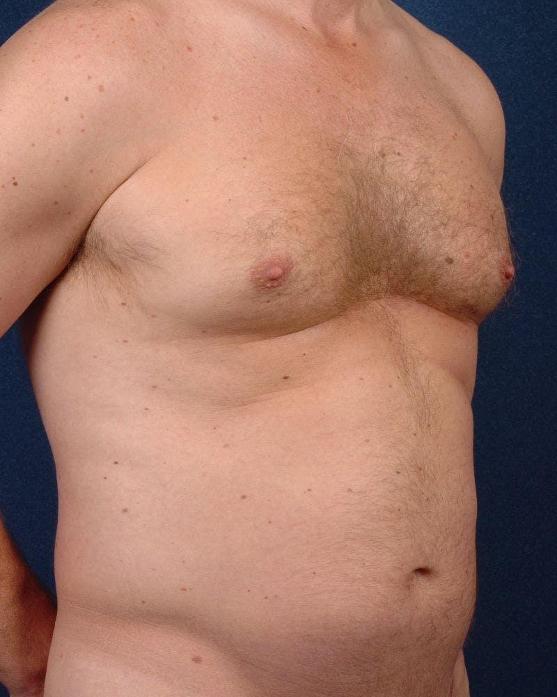 Gynecomastia Before & After Gallery - Patient 9710094 - Image 5
