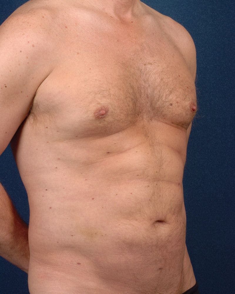 Gynecomastia Before & After Gallery - Patient 9710094 - Image 6