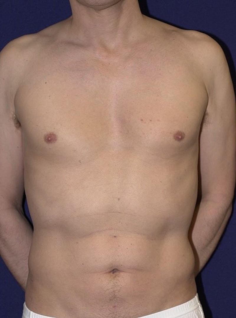 Male Liposuction Before & After Gallery - Patient 9710097 - Image 2
