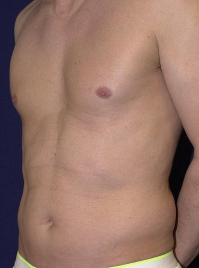Male Liposuction Before & After Gallery - Patient 9710097 - Image 3