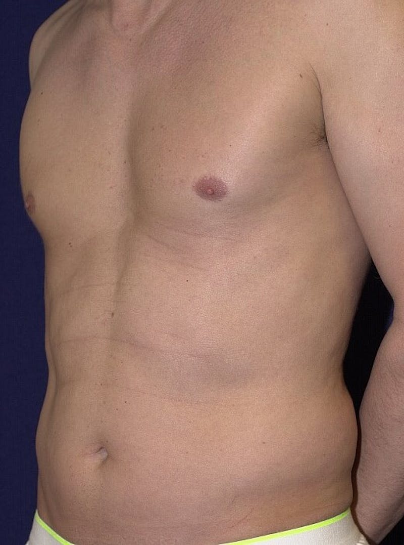 Male Liposuction Before & After Gallery - Patient 9710097 - Image 3