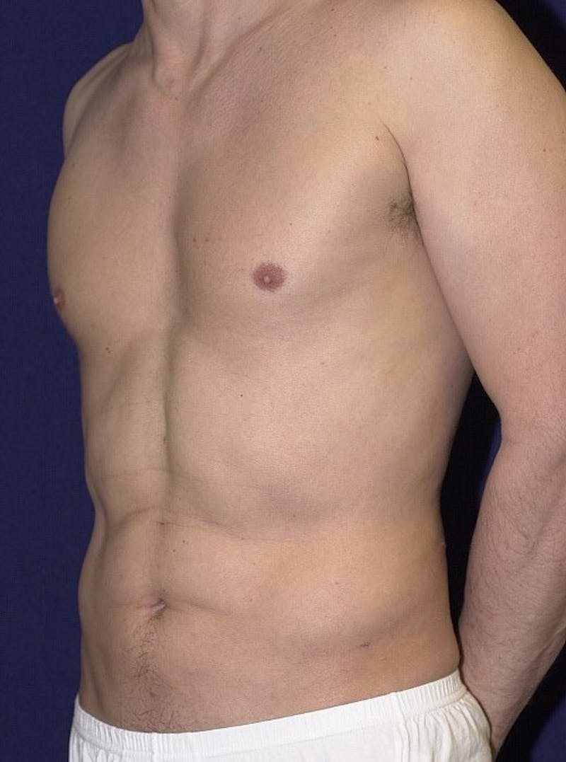 Male Liposuction Gallery - Patient 9710097 - Image 4