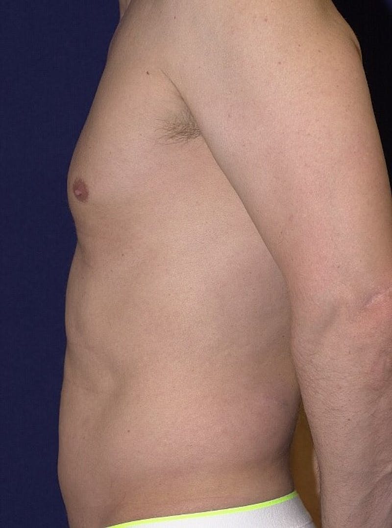 Male Liposuction Before & After Gallery - Patient 9710097 - Image 5