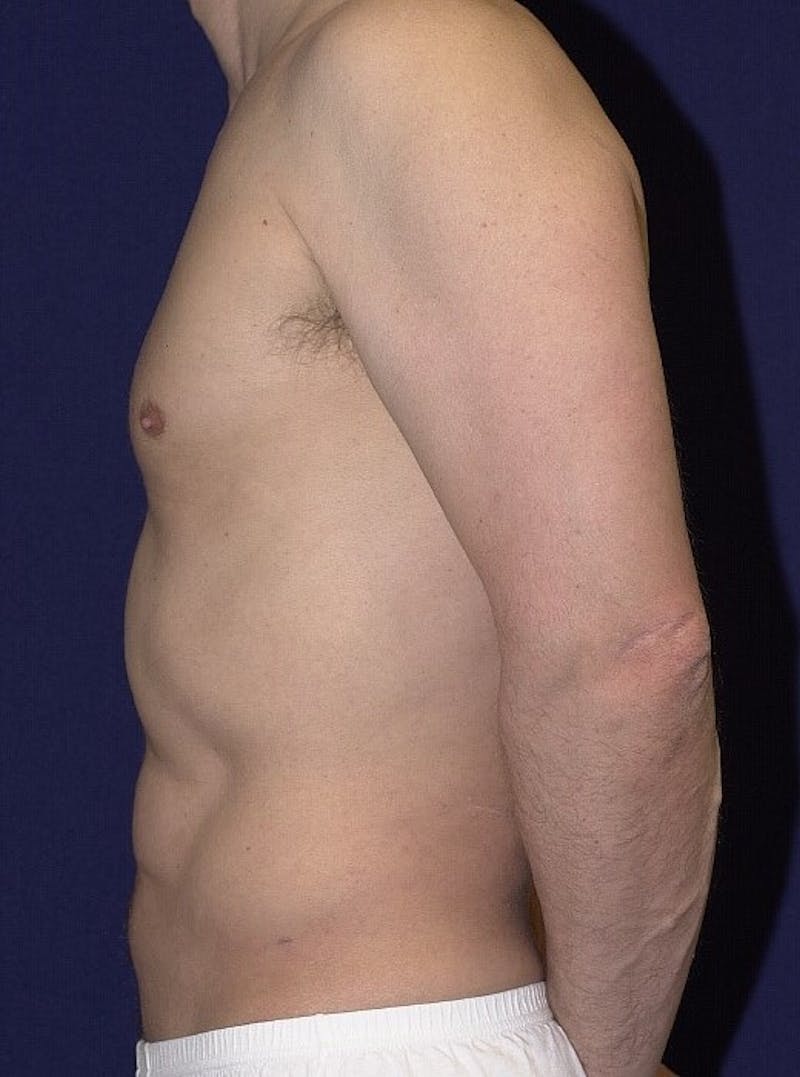 Male Liposuction Before & After Gallery - Patient 9710097 - Image 6