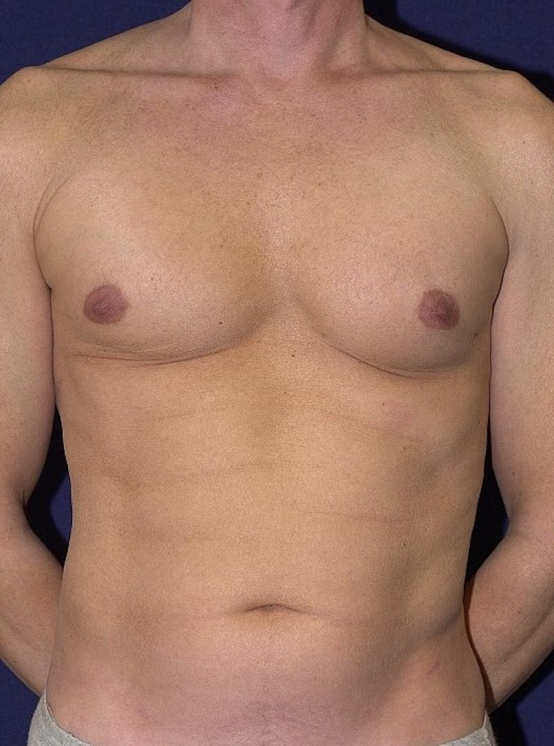 Male Liposuction Before & After Gallery - Patient 9710099 - Image 1