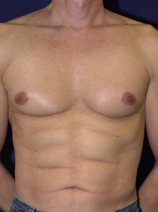 Male Liposuction Before & After Gallery - Patient 9710099 - Image 2