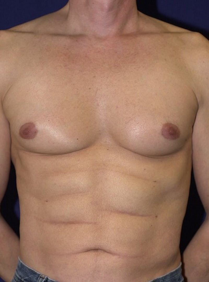 Male Liposuction Before & After Gallery - Patient 9710099 - Image 2