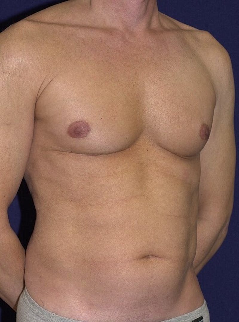 Male Liposuction Gallery - Patient 9710099 - Image 3