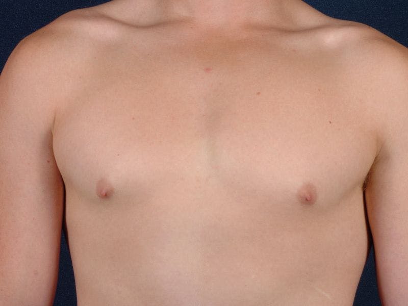 Pectoral Augmentation Before & After Gallery - Patient 9710103 - Image 1